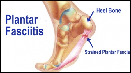 Common Foot Problems: Plantar Fasciitis | Orthopedic Institute of Sioux ...