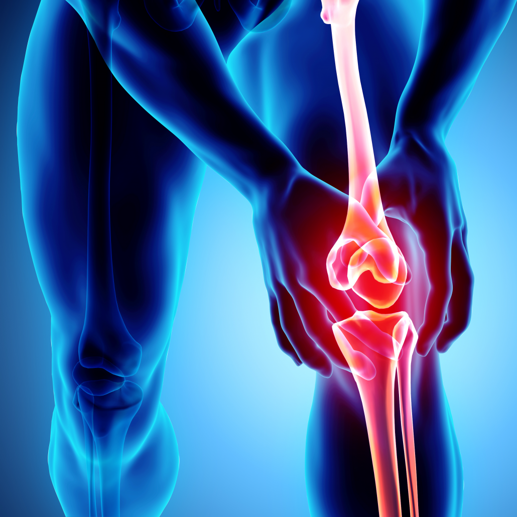 Knee Arthritis Orthopedic Institute of Sioux Falls